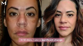 Finally fade melasma & dark spots. The results are REAL! | Musely Reviews