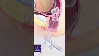 Cervical Dilation &amp; Curettage - Cervix Opening with Balloon #shorts