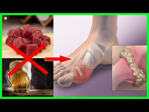 7 Foods You Should Never Eat If You Have Gout | Best Home Remedies