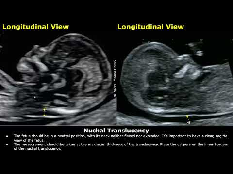 How to Measure Nuchal Translucency (NT) On Ultrasound | First Trimester NT Screening | Fetal USG