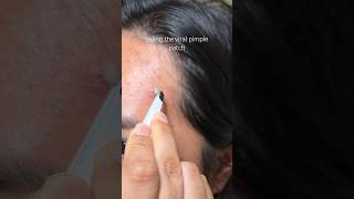 best patches 🤭 hero cosmetics mighty patch! #pimplepatch #pimplepatches #pimplesremoval #skincare