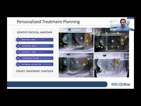 UROwebinar: Heat Free robotic treatment of Benign Prostatic Obstruction – from vision to reality