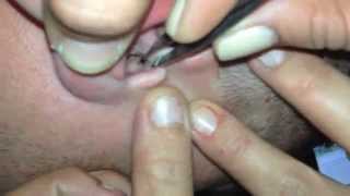 Bug Buried in Guy’s Ear