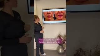 Caso real de Clef Infiltration - Clínica Dra. Pérez Sevilla