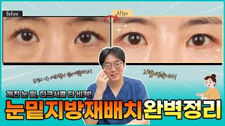 꺼진 눈, 다크서클 다 비켜! 눈밑지방재배치 완벽정리!