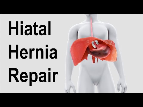 Hiatal Hernia Repair Animation