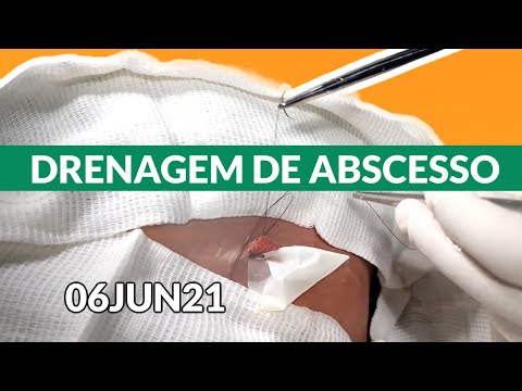 [06JUN21] DR. LUCAS DUARTE • Abscess Drainage - Drenagem de Abscesso