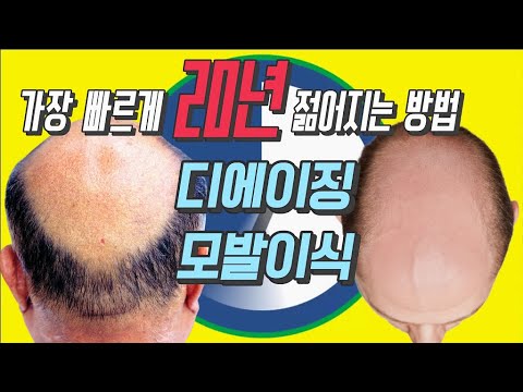 介绍毛发移植期间整形20年最快变年轻的去衰老毛发移植。