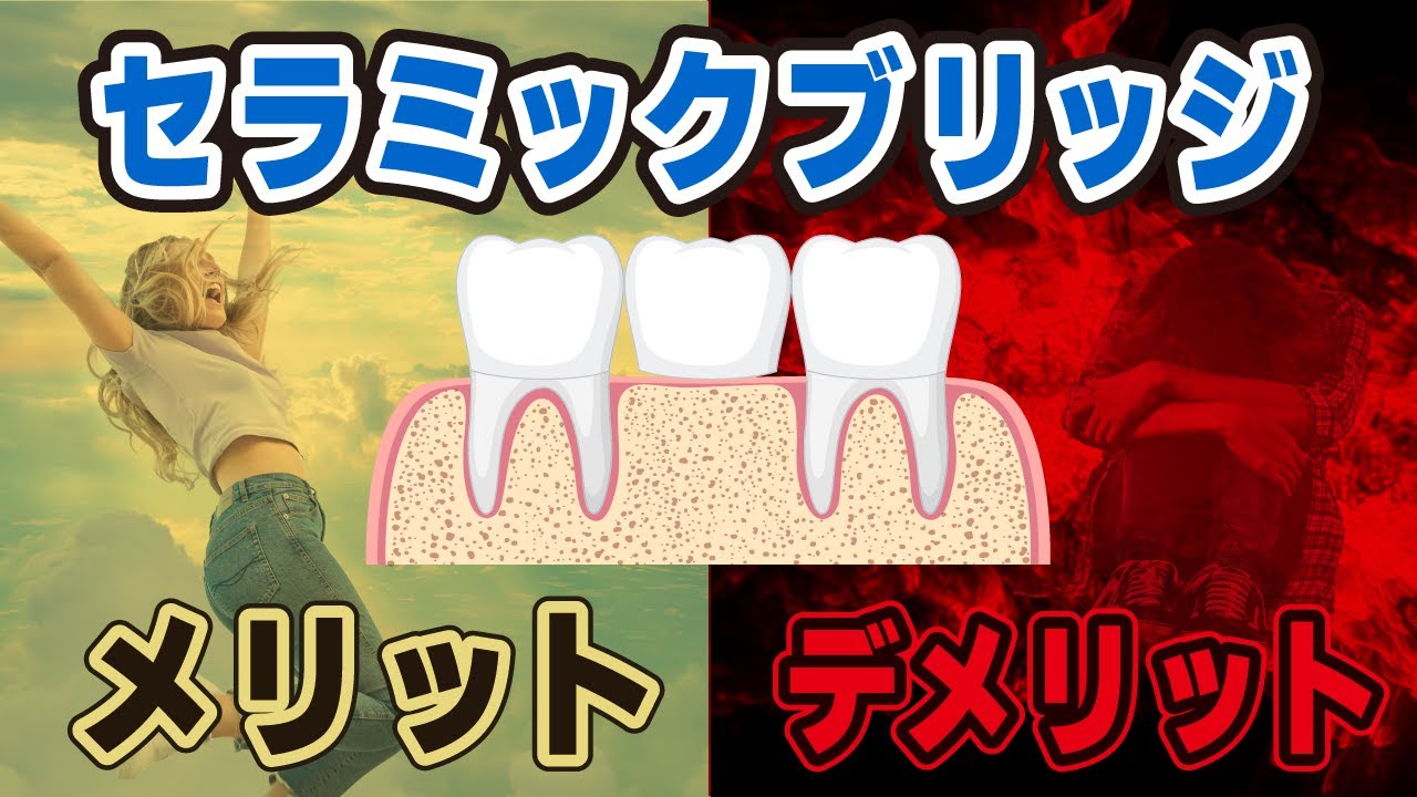 【審美歯科治療】セラミックでのブリッジ、メリット・デメリットとは?