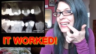 HOW I AVOIDED 3 ROOT CANALS NATURALLY - DENTISTS HATE THIS VIDEO! pt 2