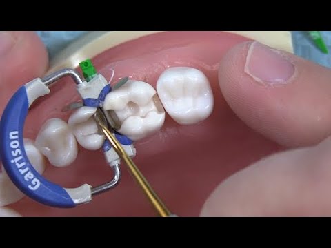 Back-to-Back Restoration Using an Incremental Approach with Dr. Jeff Davies