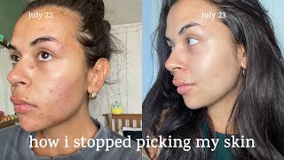 how i stopped picking my skin