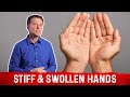 Remedies For Swollen Hands Explained By Dr.Berg