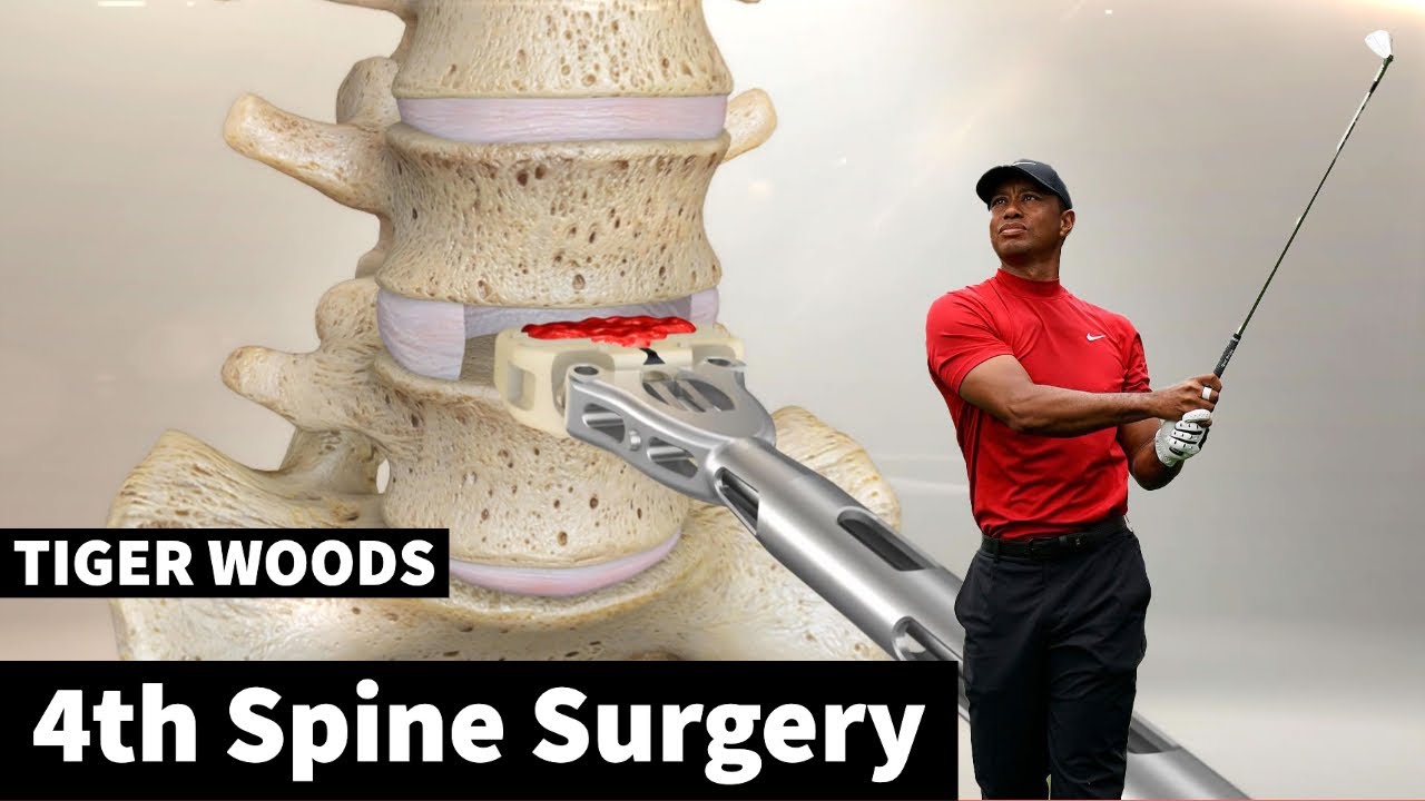 The Full Story of Tiger Woods'  4th Back Surgery - Anterior Lumbar Interbody Fusion