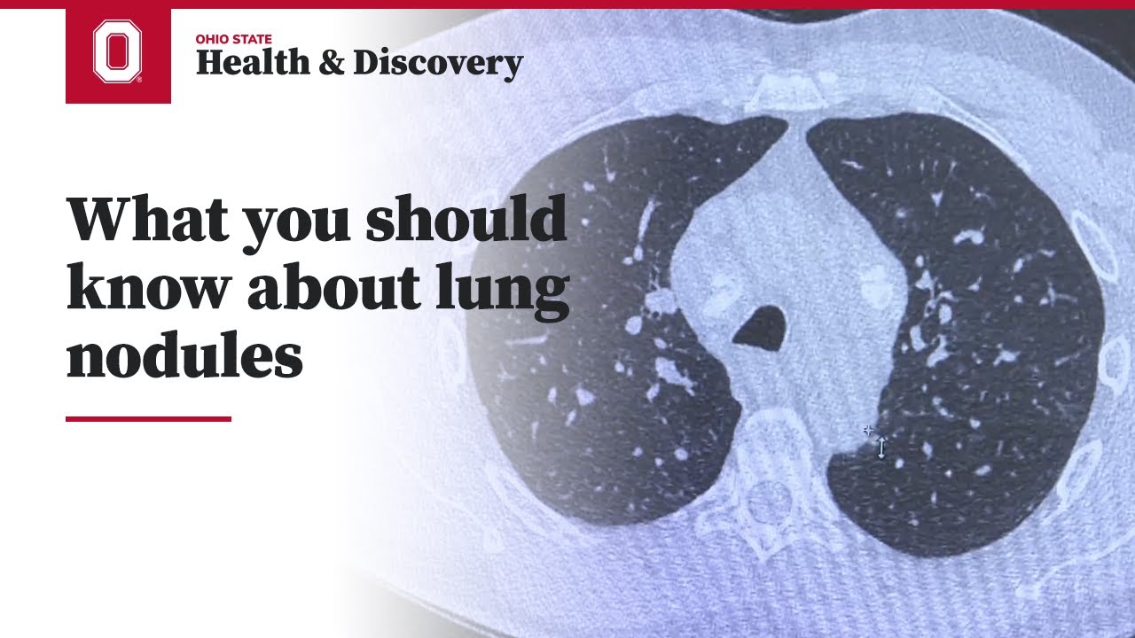 What are satellite nodules in lungs? More REF