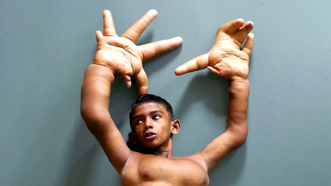 People with Extraordinarily Rare Body Parts
