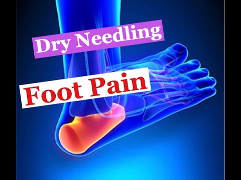 download lagu mp3 mp4 Dry Needling For Plantar Fasciitis, download lagu Dry Needling For Plantar Fasciitis gratis, unduh video klip Dry Needling For Plantar Fasciitis