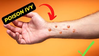 How to treat poison ivy Rashes Quickly and Effectively
