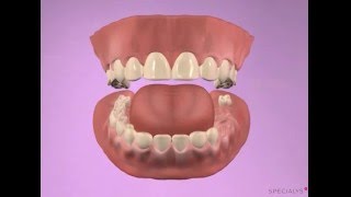 Bridge quatre dents sur trois implants