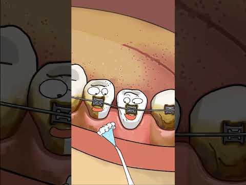 Appareil dentaire : l’astuce que ton orthodontiste ne t’a pas dite 💦