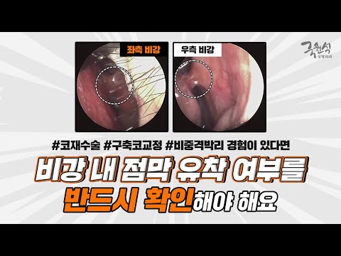 #코재수술 #구축코교정 #비중격박리 했었다면 주목! 비강 내 점막 유착을 꼭 확인해야 해요!