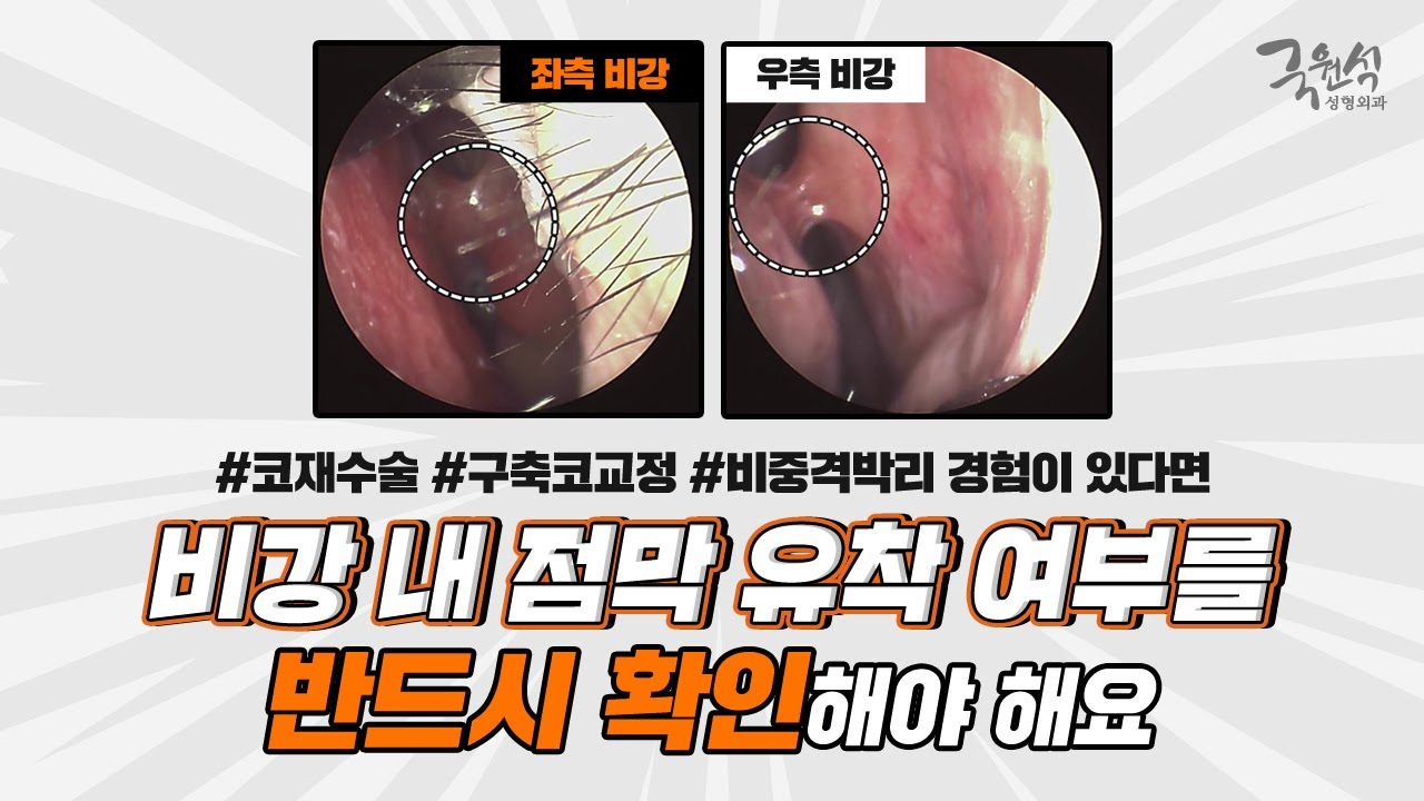 #코재수술 #구축코교정 #비중격박리 했었다면 주목! 비강 내 점막 유착을 꼭 확인해야 해요!