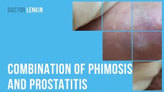 👉 Combination of phimosis and prostatitis