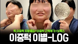 이중턱 없애기 풀패키지 시술 LOG｜얼굴지방흡입 + 근육묶기 + 보톡스