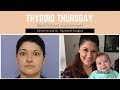 Christina’s Thyroid Eye Disease Journey – Dr. Raymond Douglas