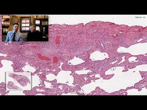 Pattern 2 - CTD Associated Fibrosing Lung Disease