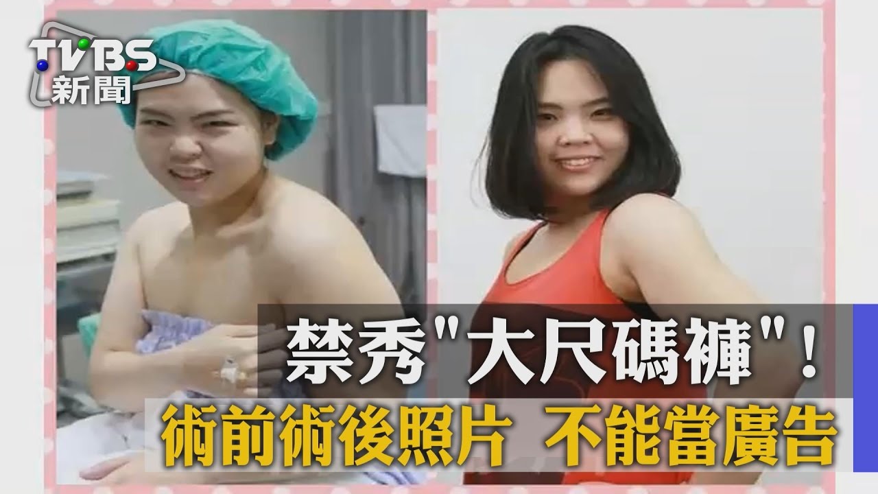 禁秀「大尺碼褲」! 術前、術後照片不能當廣告