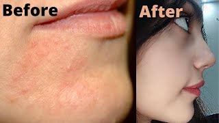 How i got rid of my Perioral Dermatitis and Steroidal acne on face | Get rid of Rosacea permanently