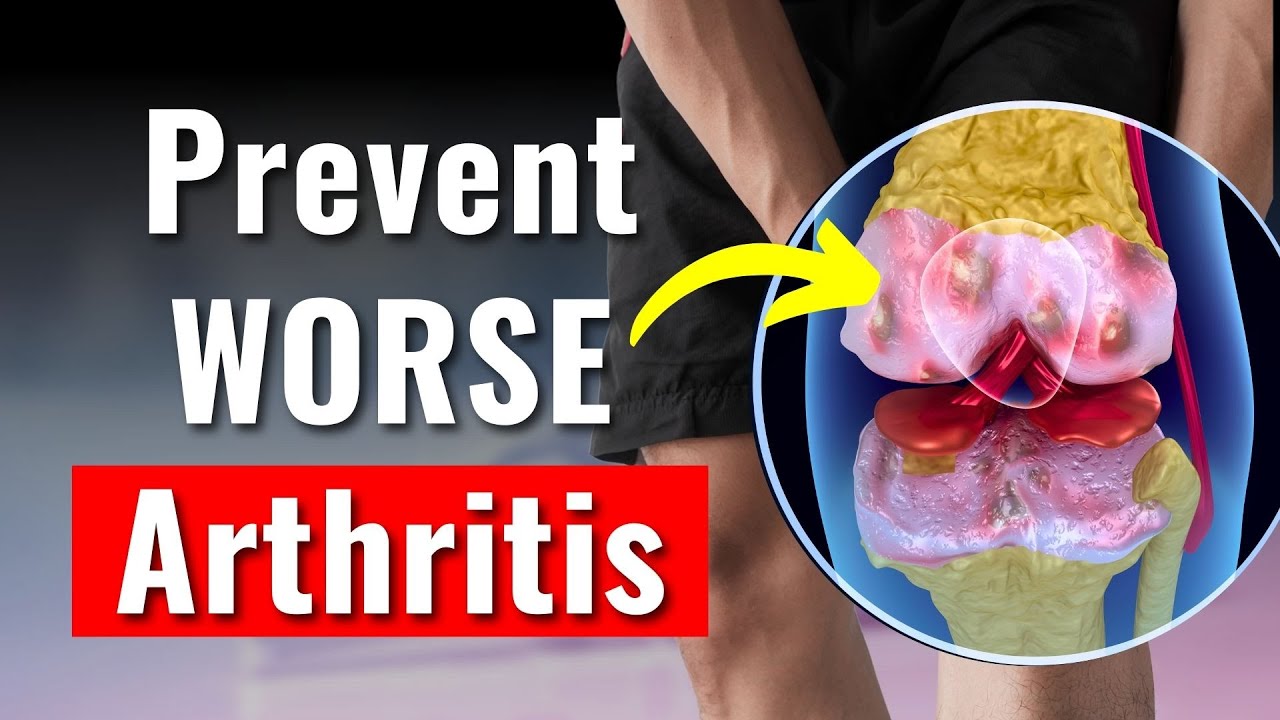 How to Prevent Knee Arthritis from Getting Worse: 3 Evidence-Based Strategies
