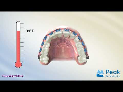 Nickel Titanium Archwires