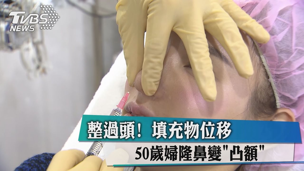 整過頭！填充物位移　50歲婦隆鼻變「凸額」