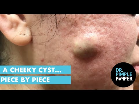 oversøisk Hejse Land Best Dr Pimple Popper Cyst Videos All Fans Must Watch
