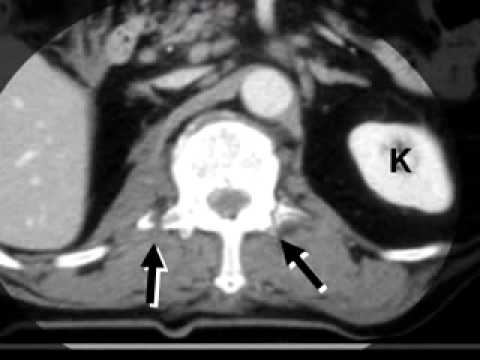LearningRadiology 14 (Thoracolumbar Fracture/Disclocations)