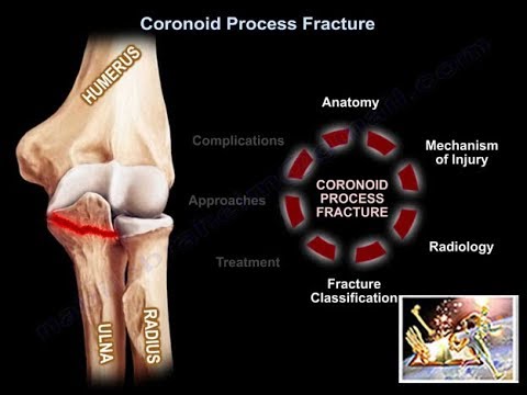 Fraktur des Processus coronoideus – Alles, was Sie wissen müssen – Dr. Nabil Ebraheim