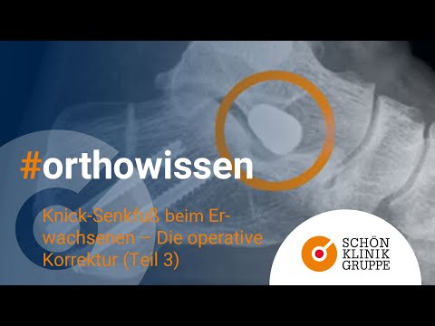 Wissensforum Orthopädie: Knick-Senkfuß beim Erwachsenen - 5 Schritte der op. Korrektur (Teil 3)