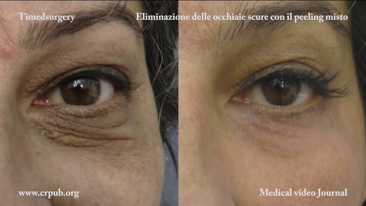 Watch Now 17. ELIMINAZIONE DELLE OCCHIAIE SCURE 17. ELIMINAZIONE DELLE OCCHIAIE SCURE