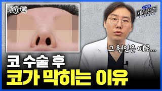 코 수술 후 코 막힘이 왜 생기는 걸까 코 막힘 해결방법과 예방법은｜코 부작용 1편