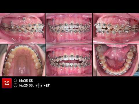2017 ABO CRE Cast   Radiograph Evaluation by Chris, Angle Lee Part 3｜CC407