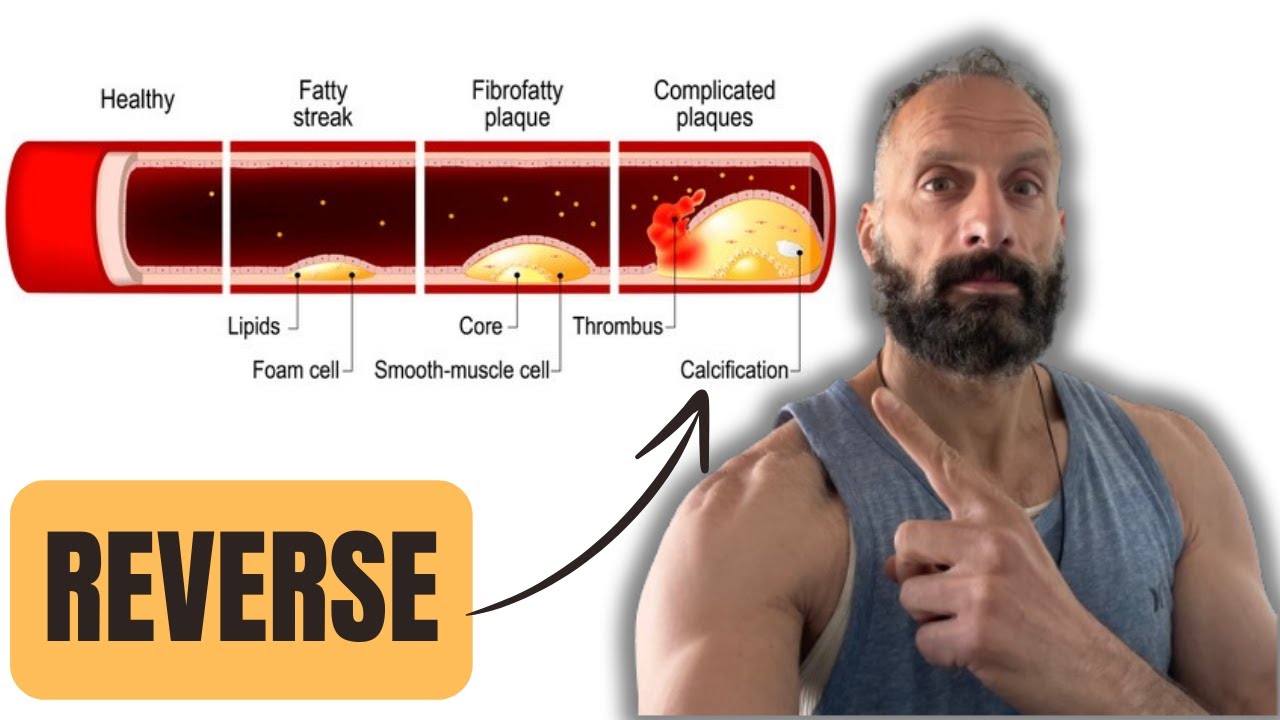 Reverse Arterial Calcification: Cavadex