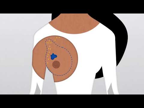 How Do Doctors Diagnose and Treat Breast Cancer?