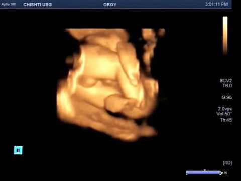 Ultrasound Video showing sex of the fetus on 4-D.