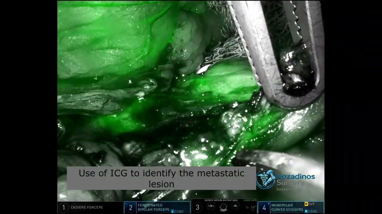 Robotic Adrenalectomy for Solitary Melanoma Metastasis - Kozadinos Surgery