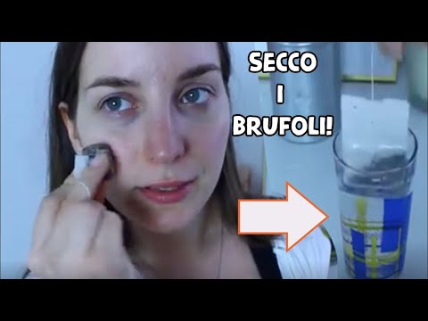 brufolo sulla clavicola