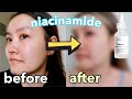 I Tried The Ordinary Niacinamide 10 Zinc Every Day For A Week Before After