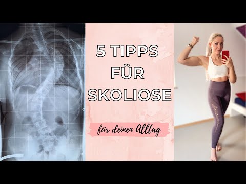 5 Tipps für Skoliose // Hilfe bei Skoliose // Übungen und Mindset mit Skoliose //