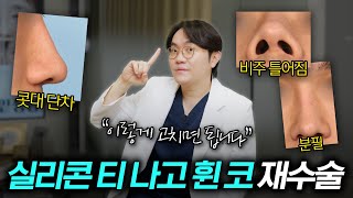 EDITION TV - 두 번의 수술을 받았지만 휘어지고 길어진 코 | 남자 코재수술 케이스 리뷰